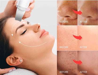 Ultrasonic Vibration Skin Scrubber and Blackhead Remover